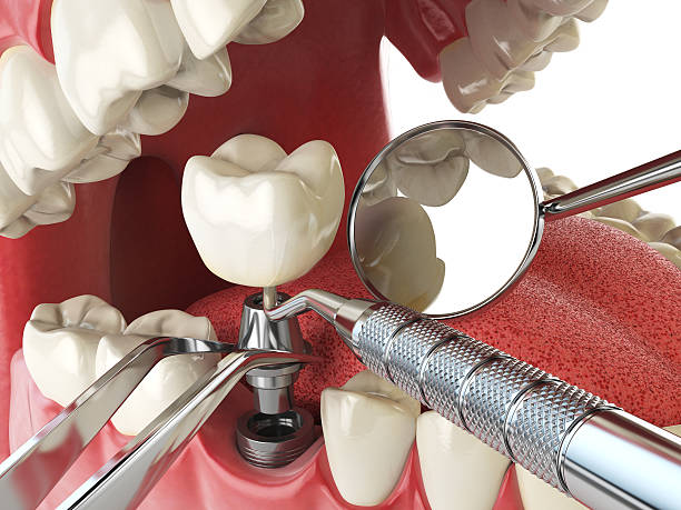 Best Dental Abscess Treatment in Boiling Springs, PA